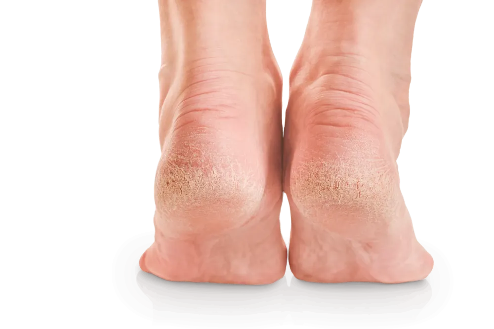 pieds abimés (1)