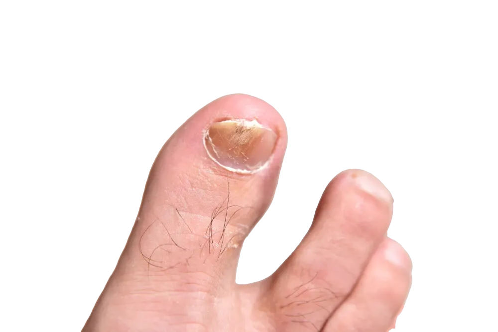 ongle mycosé à Six-Fours-les-Plages